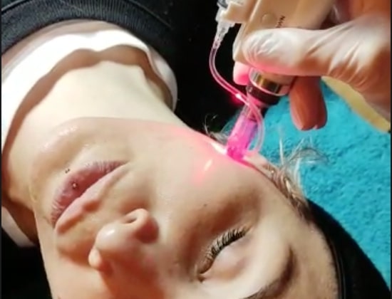 Vorschaubild Video: Micro Needling im Kosmetikstudio Nikola